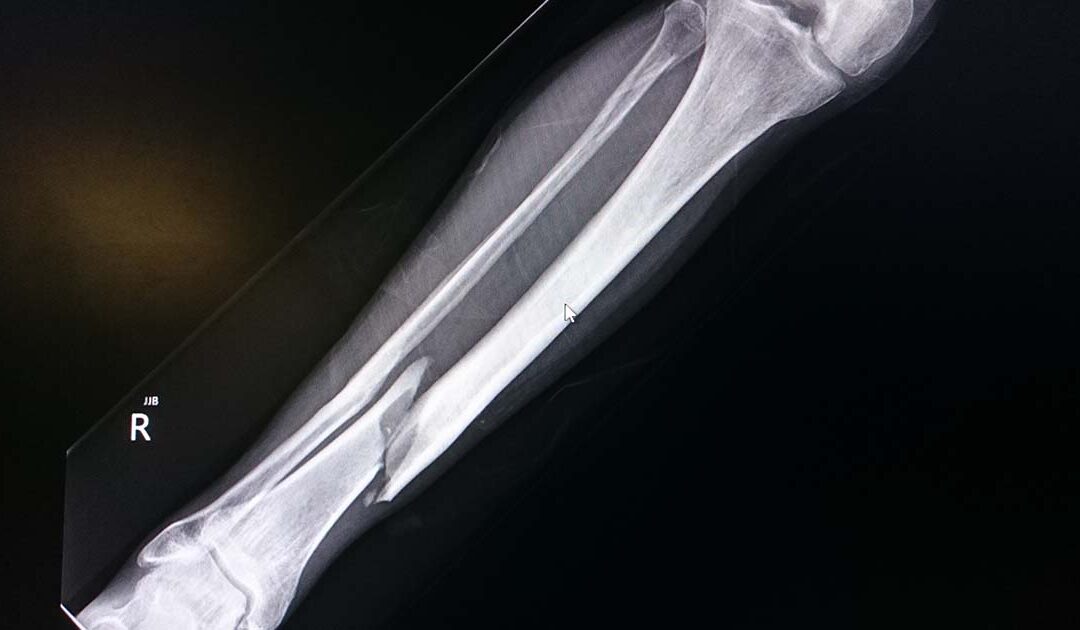 Broken leg bones